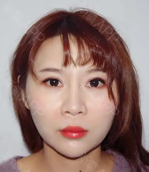 氧气ahb9682玻尿酸丰鼻基底第1天美丽日记