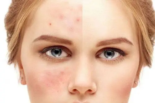 源自护肤官网-专业指导敏感肌肤-关注敏感肌肤修复|激素脸治疗