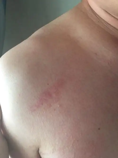 我想知道这个是不是吻痕