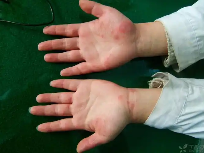 【求助】像不像寒冷性多形红斑