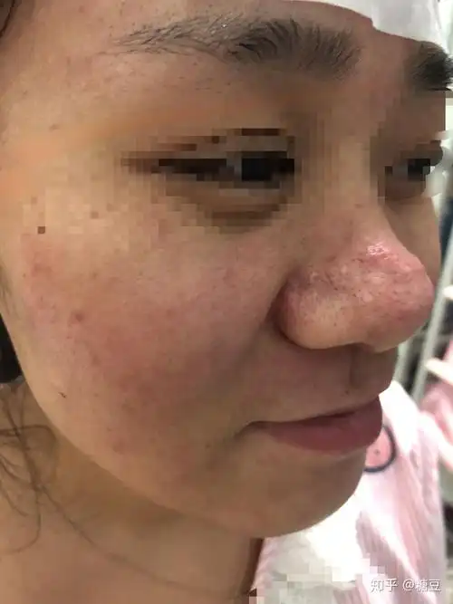 酒糟鼻点阵激光记录 - 知乎