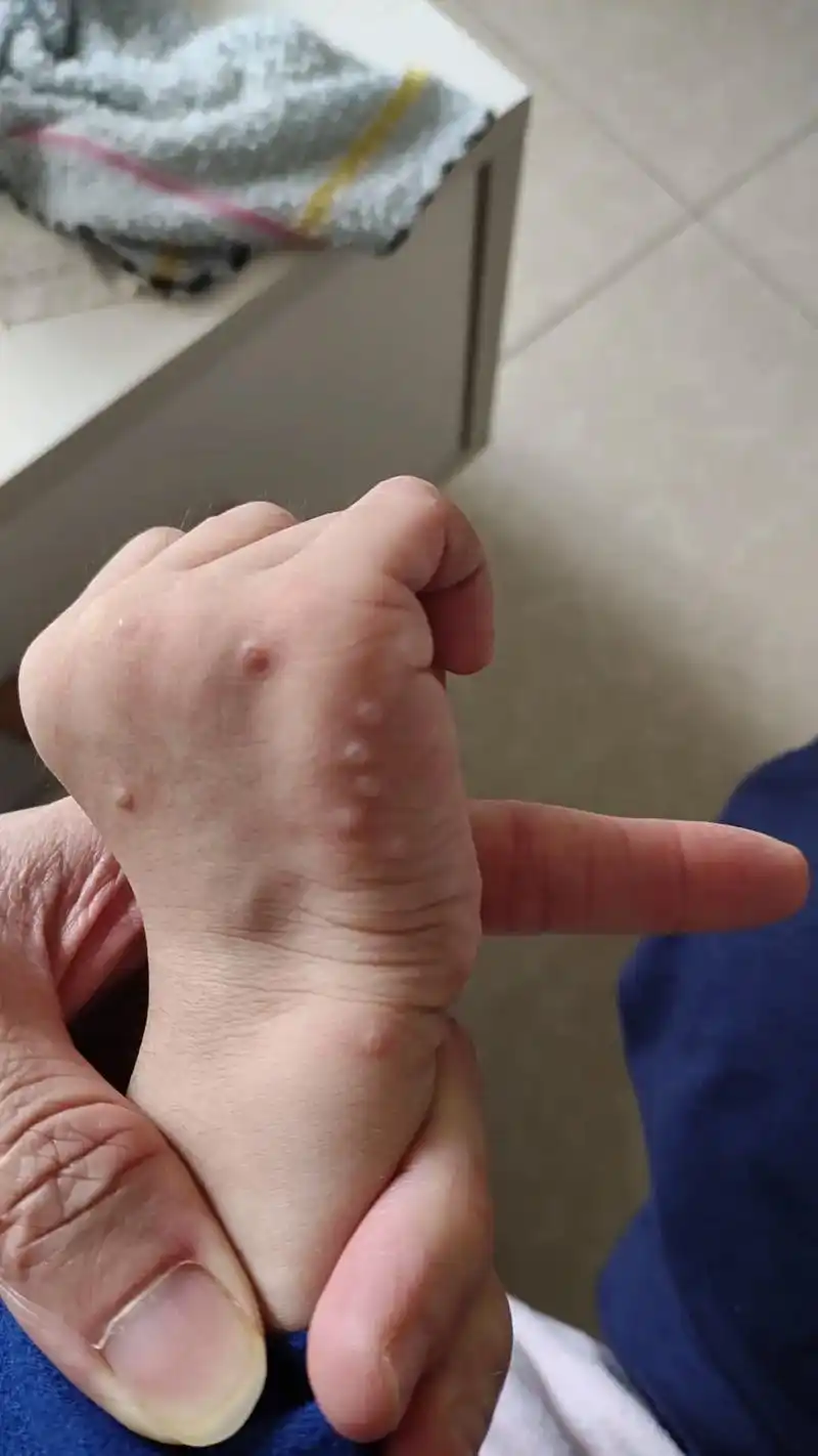 同一个地方第一个图片今天刚刚拍照的什么这水痘泡又长了这大,第 - 抖