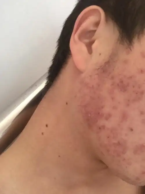 脸上痘痘下去之后留下满脸的红印,这是痘印吗? 过一段它会自行消退吗?