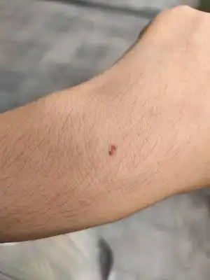 手腕上多了两个血点妈耶这什么鬼0606