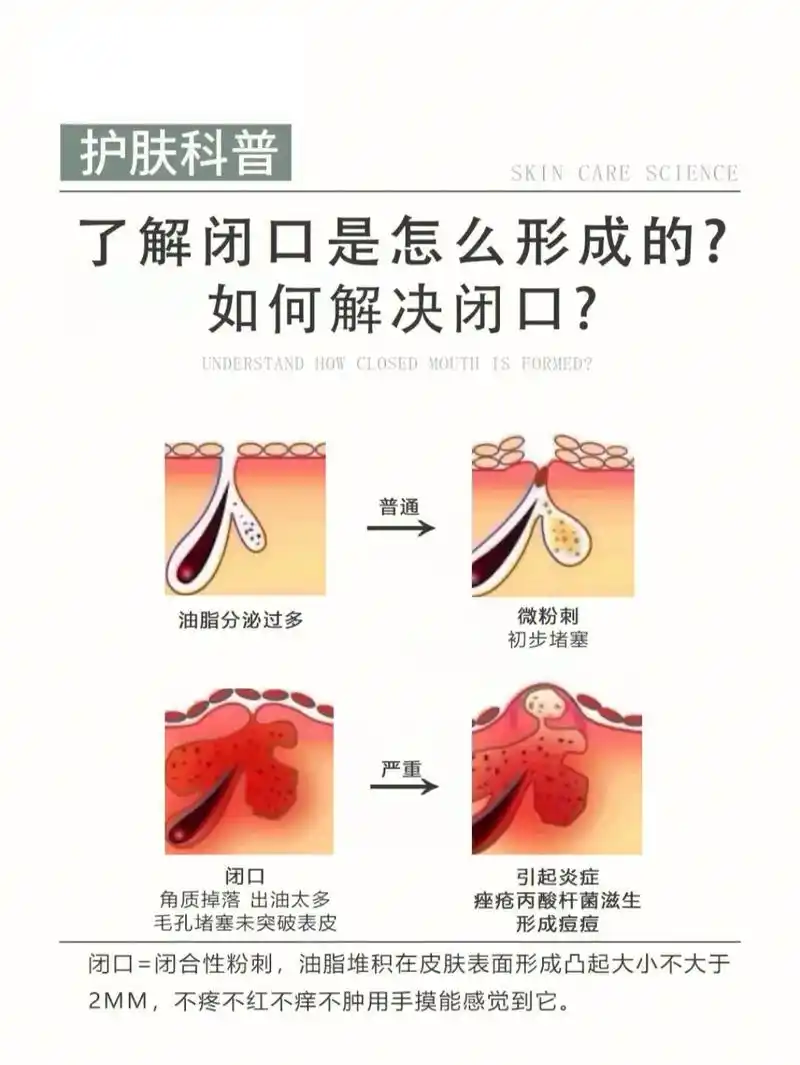 科普|闭口是怎么形成 - 抖音