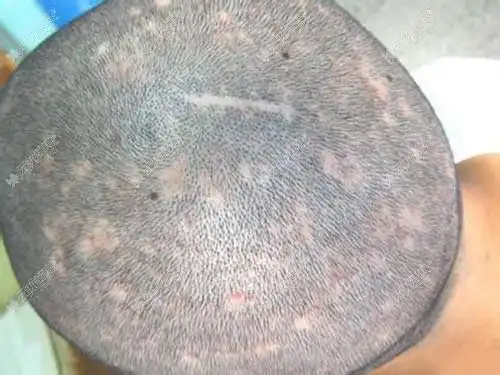 毛囊炎是细菌性皮肤病,完全是因外界细菌感染皮肤毛囊而产生毛囊疾病.