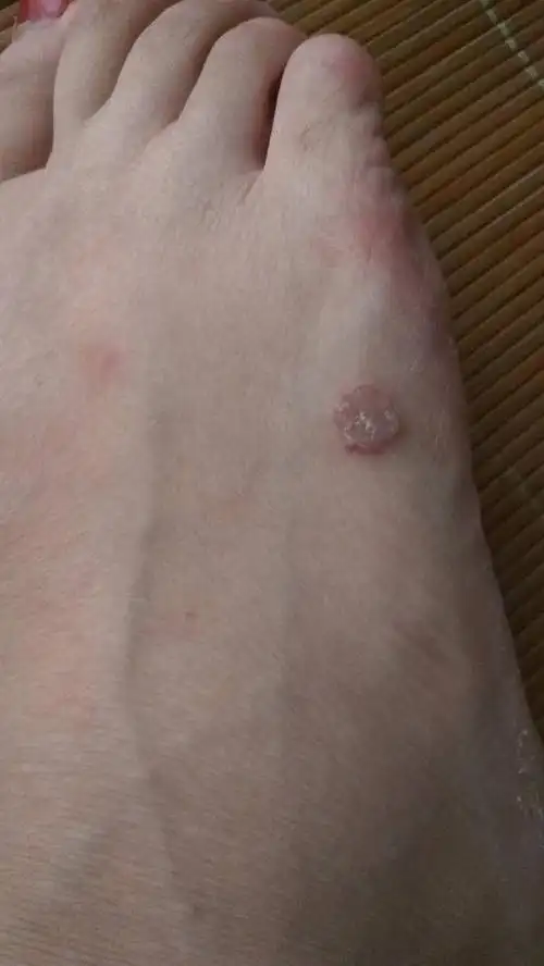 脚上长了这种黑色的疙瘩,用手可以扣掉但还是会长~这到底是什么啊