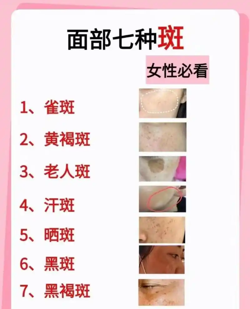 黄褐斑:呈现为比雀斑略大的深褐色斑点,通常出现在面部以及暴露在