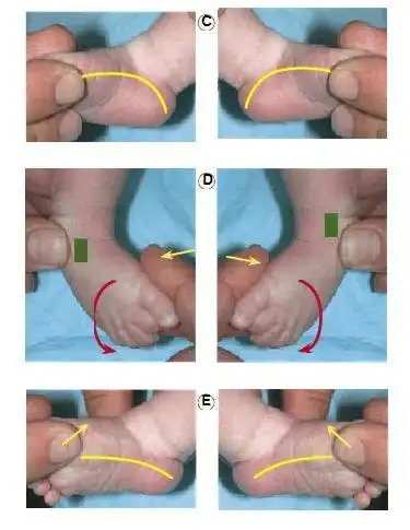 先天性马蹄内翻足 - 好大夫在线