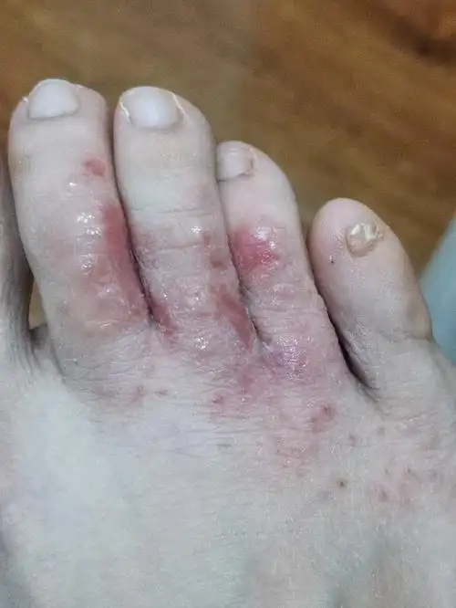 脚趾头之间有裂口 也涂药了 可是不见好 怎么办啊