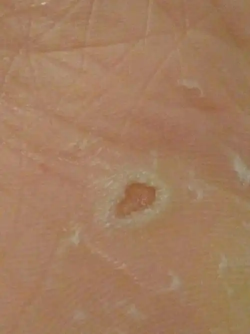 脚底有个洞,周围突起中间凹了个洞,平时走路有点痛,按着周围痛.