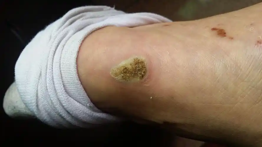 我的脚上长了8个跖疣半年多了,跪求良药秘方啊!不甚感谢!