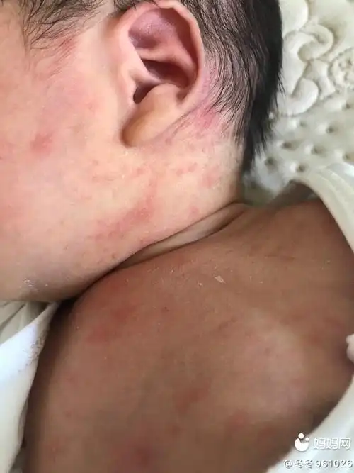 我宝宝出生第五天 这是什么啊,一热就更明显,不热的话就是小红点,家里