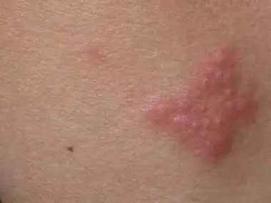 蛇盘疮初期图片