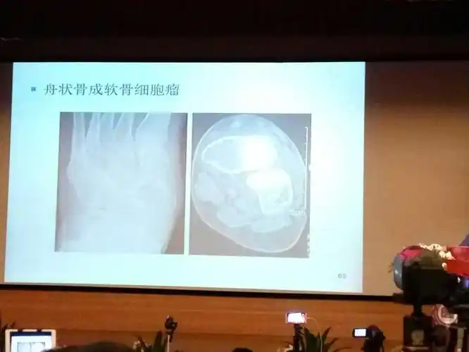 足部骨肿瘤的诊断与鉴别——丁建平(杭州师大附院)