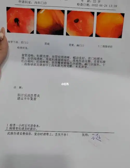胆汁反流性胃炎