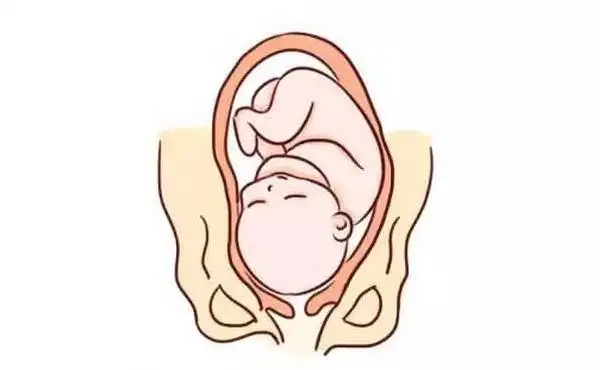 胎位不只有roa,loa,rop这几种类型,异常胎位要早知道 - 相因