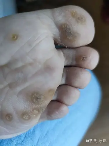 我的跖疣治愈历程