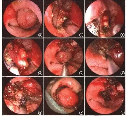 鼻子堵一年,一检查出大事-搜狐