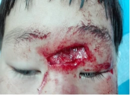 外伤后有伤口,找谁来缝针? - 好大夫在线