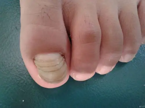 典型病例——甲横沟