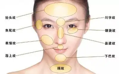 上海做鼻背纹除皱针怎么注射