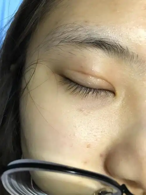 您好我2月做了全切双眼皮左右不对称瘢痕是凹进去的肉条