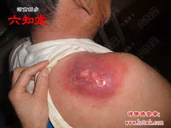 背肩粉瘤抓破感染