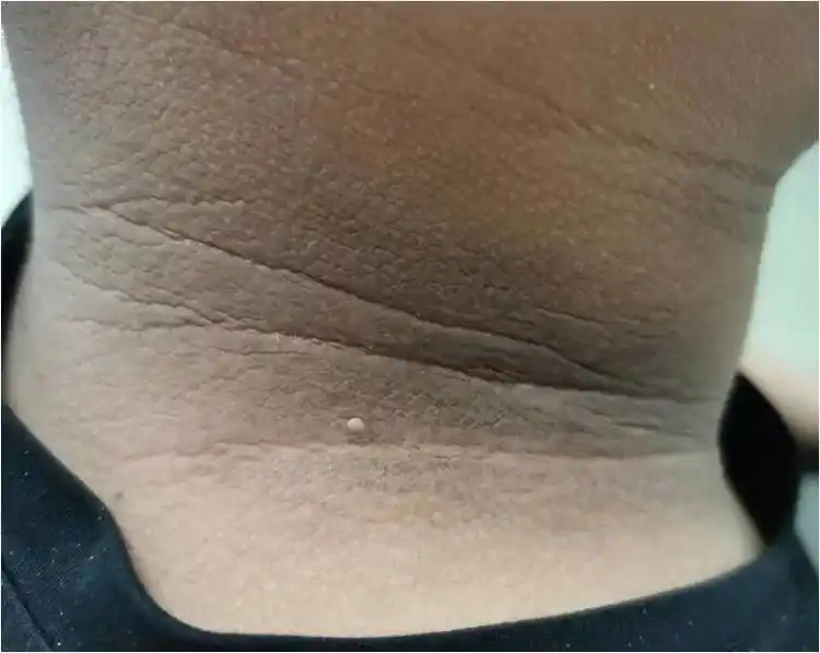 (黑棘皮病患者颈部正面色素沉着)