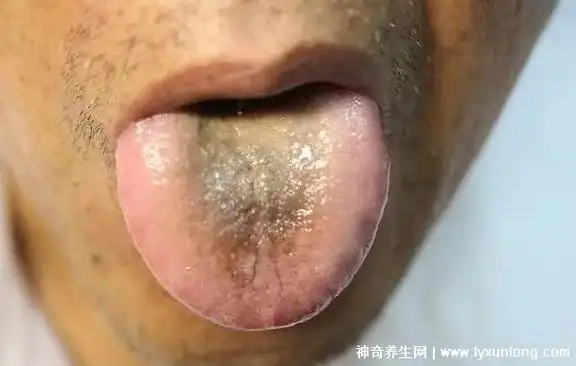 舌苔发黑图片对照,一旦发现千万别大意(脾胃失调/胃癌/尿毒症)