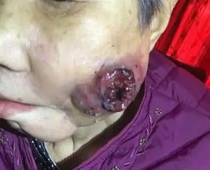 北京牙龈癌专家_北京治疗牙龈癌哪个专家好_北京治疗牙龈癌最好的专家