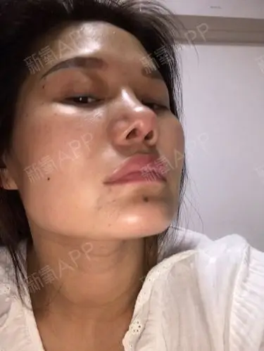 鼻子取假体后严重增生,已经五个月了,希望医生能帮我修复,严重