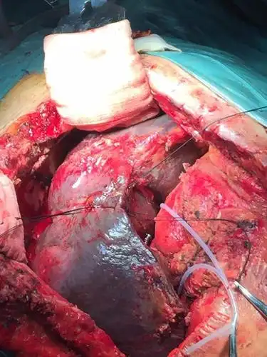 输血1万多毫升的肝静脉撕裂性肝破裂 - 好大夫在线