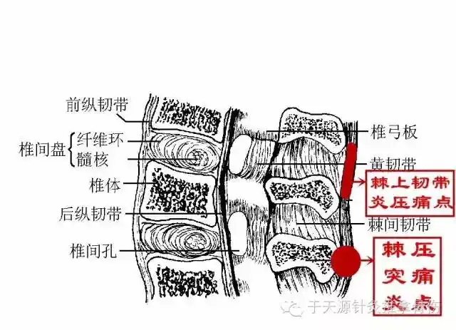 棘上韧带劳损,棘突炎的中医伤科辨证是典型的瘀血疼痛.
