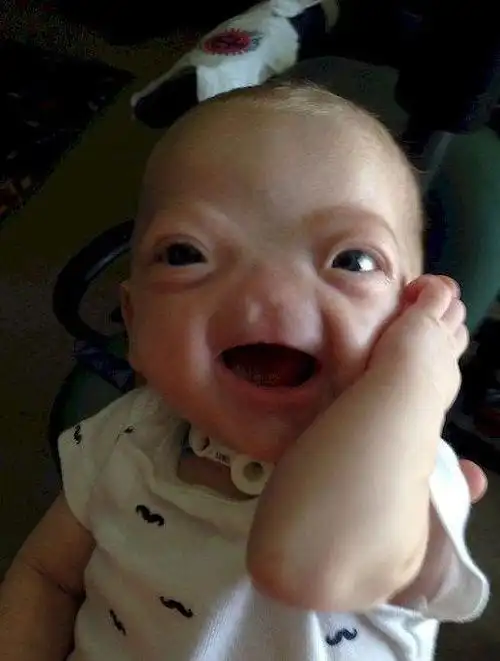 天生无鼻宝宝一个无鼻美国小孩在2015年出生后,感动了无数人,让人悲伤