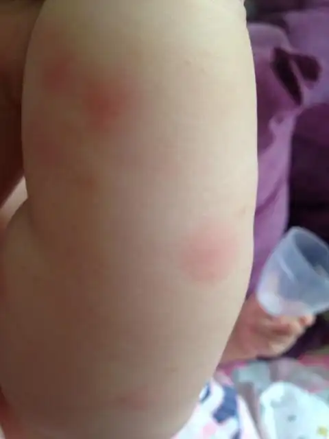 宝宝胳膊起红点不痒是什么啊