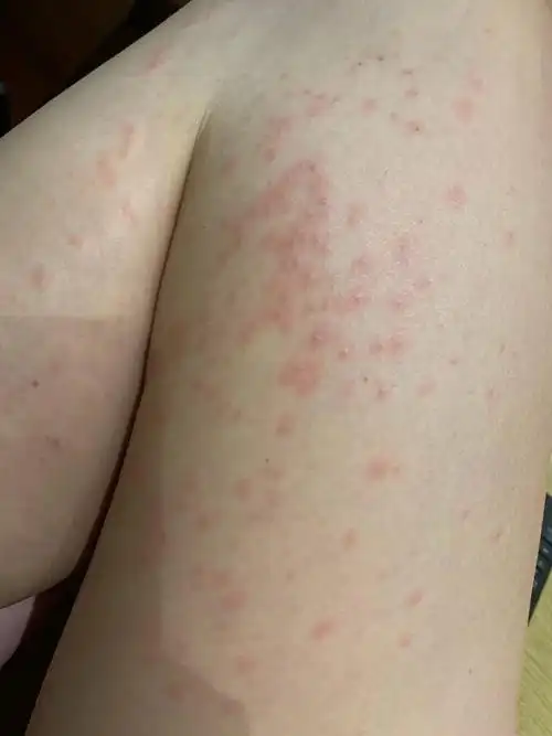 陈乔恩满腿都是疹子,看着都心疼!晒出照片大吐苦水