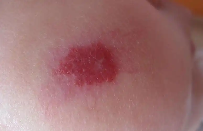 鲜红斑痣不治疗有危害吗?-搜狐大视野-搜狐新闻