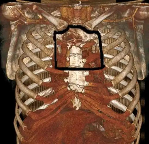 最后发现:胡先生复发的肿瘤几乎是从胸骨柄"长出来",与胸骨体上端交界