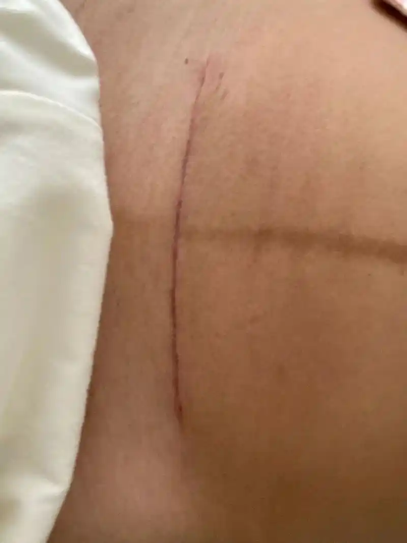 刨腹产刀口红红的 术后一个月了 伤口红红的 目前什么也没用 该用点