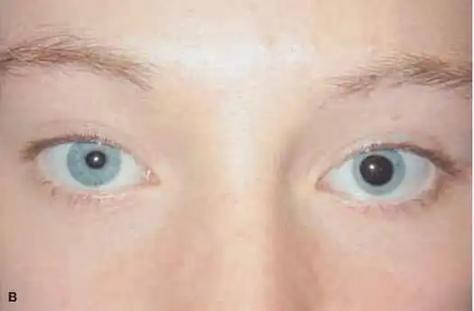 horner综合征 - 好大夫在线