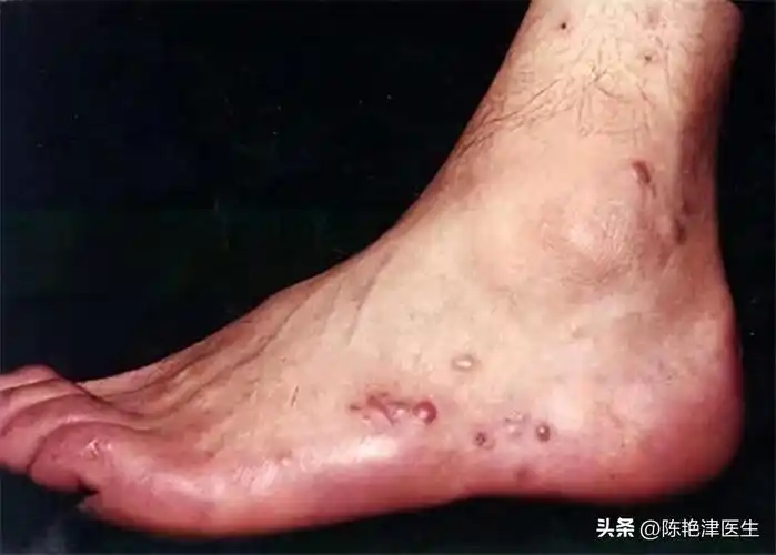 艾滋初期身上痒挠完照片(3个异常或是艾滋病早期症状)