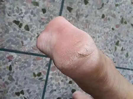 肛门好像裂开是怎么回事