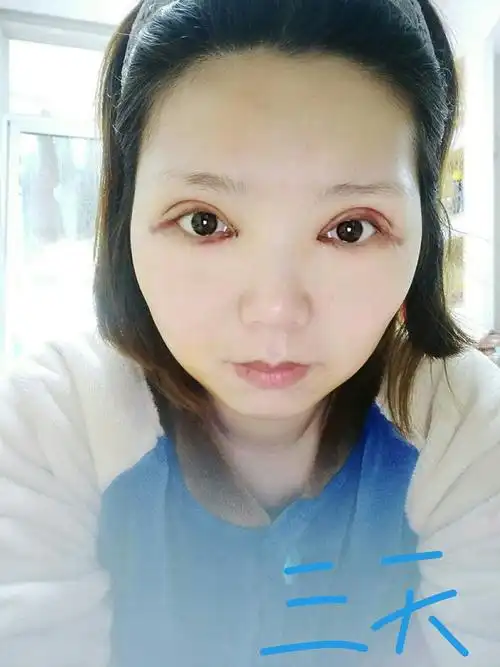 全切双眼皮开眼角记录4月19号一个月了武汉