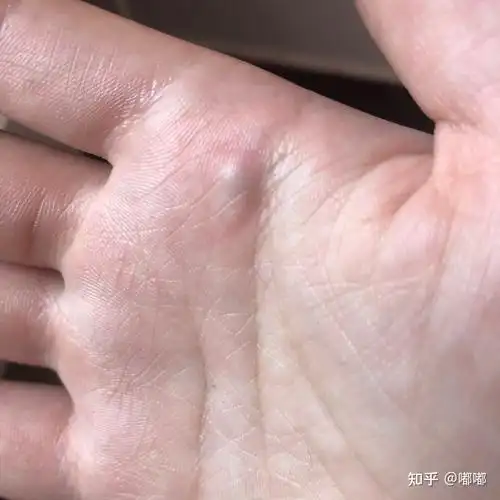 手掌长了一个绿色疙瘩一摁就疼去医院医生也不知道