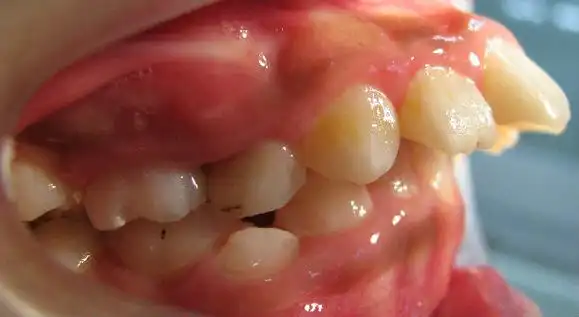 12岁前必须矫正的儿童牙颌畸形