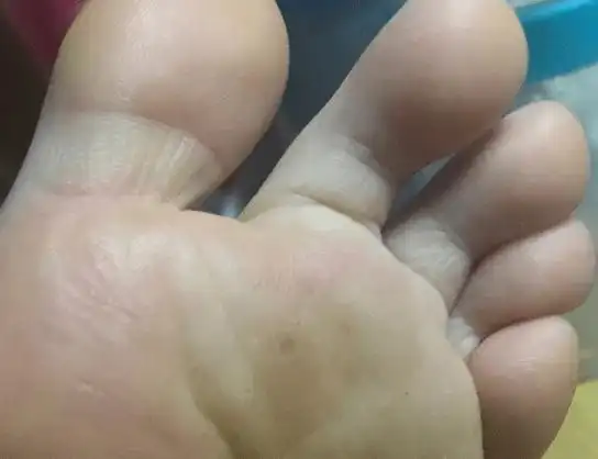 我们的脚指甲大部分都是粉红色的,硬度适中,不爱破裂,如果肝脏出了