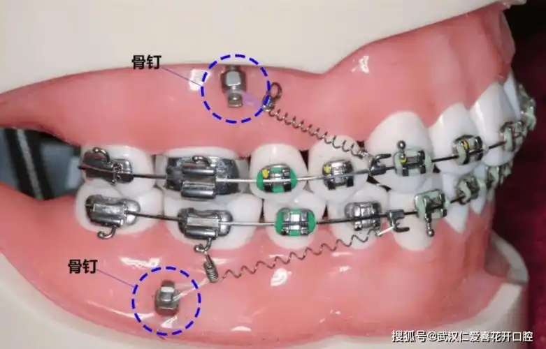 迷你骨钉简称骨钉,又叫支抗钉,种植钉,学名"种植