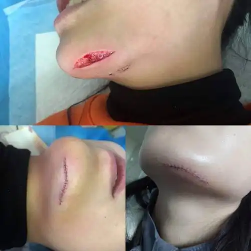 美容缝合那些事