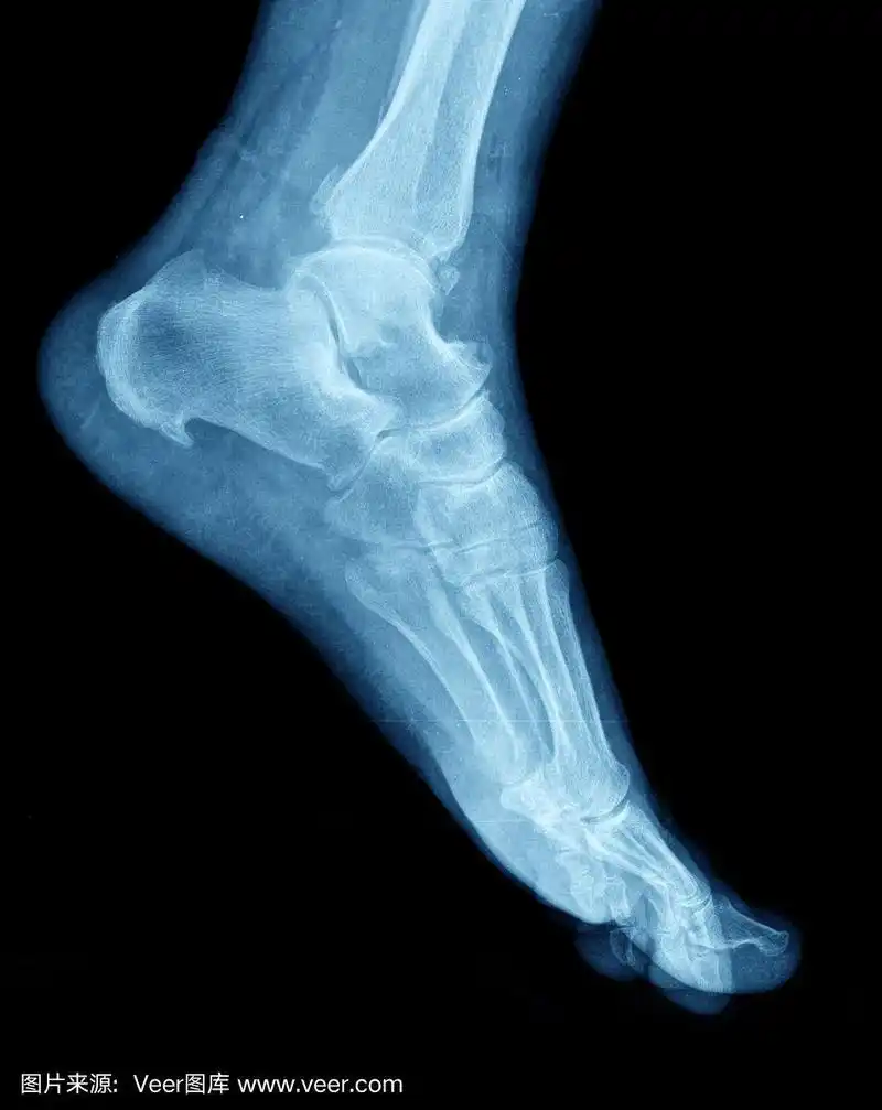 脚部侧面的x光片